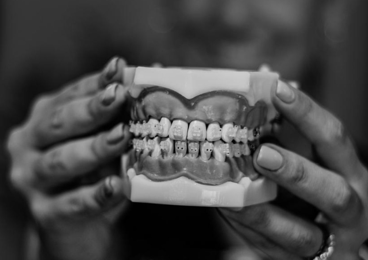 Orthodontics Orthodontics at UV Dental