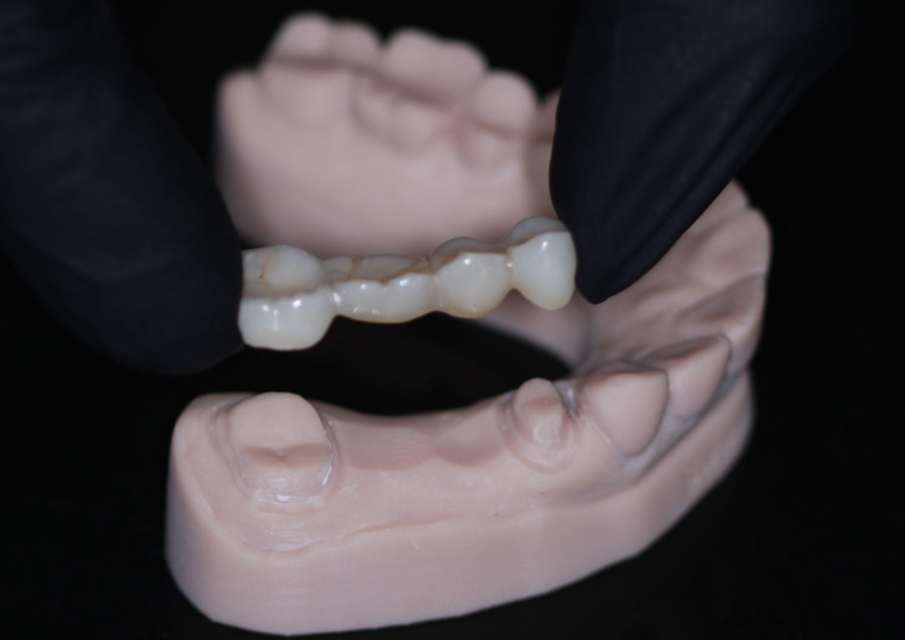 crowns-and-bridges-vos Crowns and bridges at UV Dental